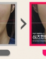 안면비대칭 전후사진입니다.