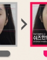 눈썹, 입꼬리 안면비대칭 전후사진입니다.